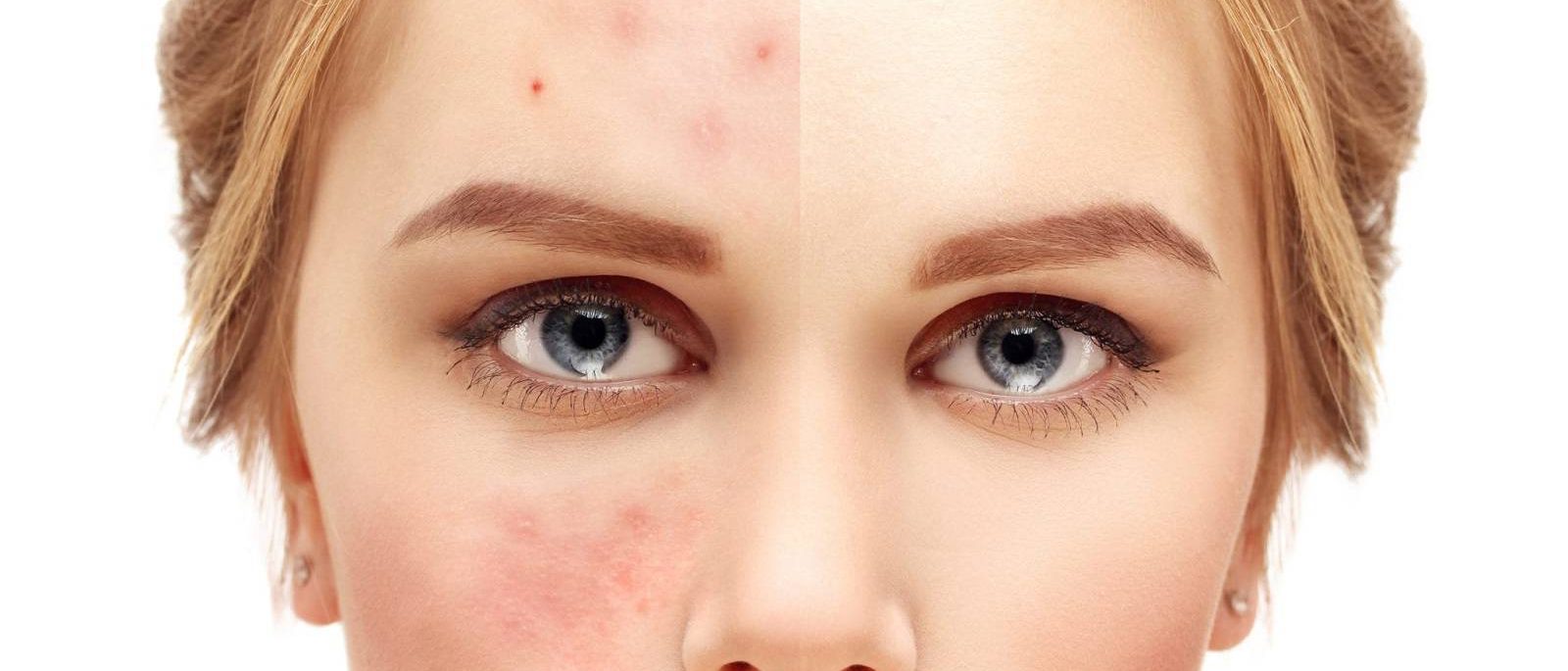 روش‌های حیرت‌آور برای درمان جوش صورت