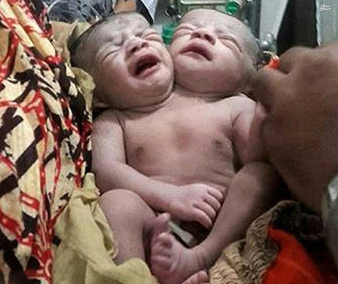 عکس/ تولد نوزاد دو سر در بنگلادش