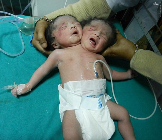 عکس/ تولد نوزاد دو سر در بنگلادش